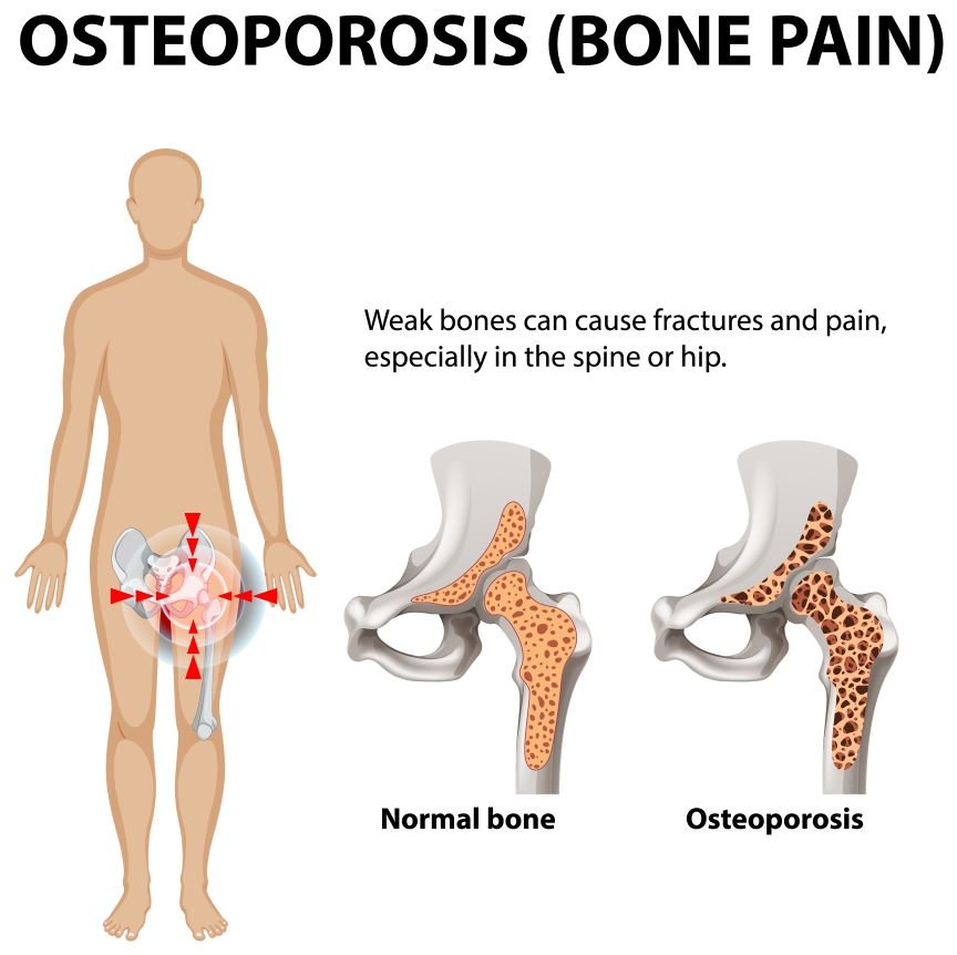 OSTEOPOROSIS