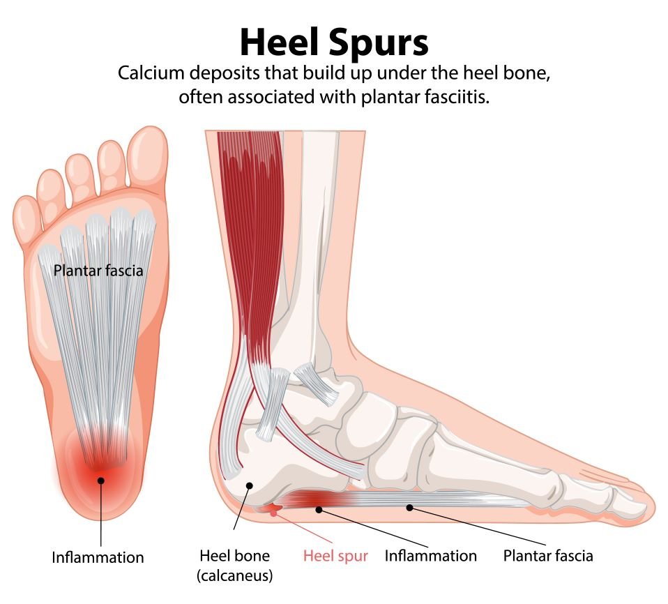 PLANTAR FASCIATIS